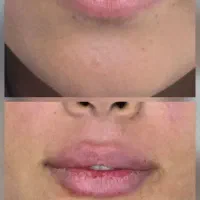 بوتاکس،فیلر، مزو فقط توسط پزشک بدون چهره مصنوعی