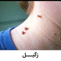 جشنواره درمان تضمینی لک و کک و مک / فقط در 1 جلسه