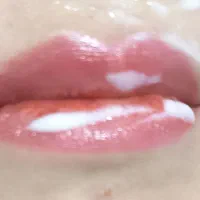 ژل ، بوتاکس و پی آر پی. سابسیژن. فیشیال. کارمندان