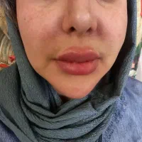 تخفیف آرایش دایم و تزریق  ژل درمطب|خدمات آرایشگری و زیبایی|شاهین‌شهر, فردوسی|دیوار