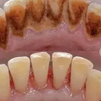 جرم گیری دندان تقریبا رایگان