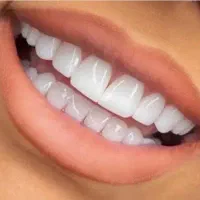 ایمپلنت. کامپوزیت.لمینت .روکش. عصب کشی