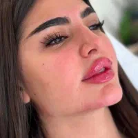 بوتاکس مصپورت۷۴۰