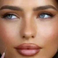 فیلرچانه ولب تزریق ژل لیزرمادلینگ پزشک