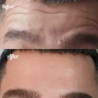 ژل و بوتاکس