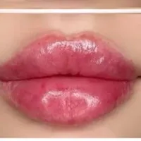 ژل و بوتاکس