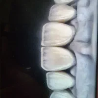 ایمپلنت با روکش 12 میلیون