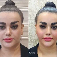 تزریق چربی|خدمات آرایشگری و زیبایی|تهران, تهرانسر مرکزی|دیوار