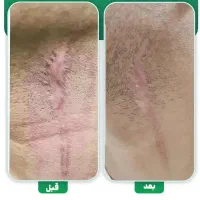 لیزر و رفع رد بخیه و اسکار|خدمات زیبایی و سلامت|مشهد, احمدآباد|دیوار
