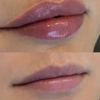 مدل ژل /فیلر /بوتاکس|خدمات آرایشگری و زیبایی|باقرشهر, |دیوار