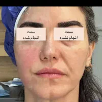 پکیج اقتصادی جوانسازی و لیفت اندوهایفو دکتر داریوش|خدمات آرایشگری و زیبایی|مشهد, راهنمایی|دیوار