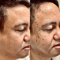 رفعhpv|آرایشی، بهداشتی، درمانی|دزفول, |دیوار