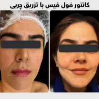 تزریق چربی صورت با ماندگاری ۱۰ ساله - دکتر واحدی|خدمات آرایشگری و زیبایی|قزوین, |دیوار