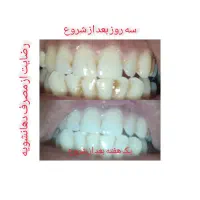 رفع بوی بد دهان