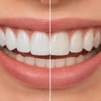 طراحی لبخند/ ایمپلنت اقساطی