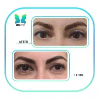 بلفاروپلاستی با قیمت استثنایی