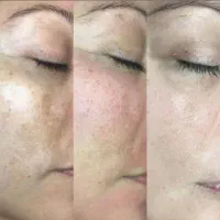 مزو وایت کرم پودر دائمی مزو نیدولینگ تخفیف ویژه