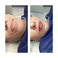 میکروبلیدینگ تغییررنگ تیره به روشن  وبوتاکس۴۵۰|خدمات آرایشگری و زیبایی|رشت, باهنر|دیوار