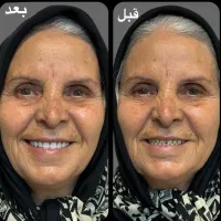 دندانسازی ساخت دندان مصنوعی ژله ای