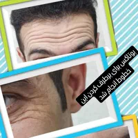 لیزر تزریق بوتاکس ژل فیلر مزوتراپی هایفو توسط پزشک|خدمات آرایشگری و زیبایی|پرند, فاز ۲|دیوار