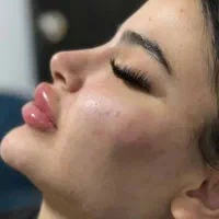 4 سی سی تزریق فیلر یک سی سی فیلر رایگان|خدمات آرایشگری و زیبایی|تهران, نیروی هوایی (پیروزی)|دیوار