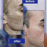 درمان همیشگی تورفتگی پوستی/ جای جوش/اسکار/سالک|خدمات آرایشگری و زیبایی|اصفهان, احمدآباد|دیوار