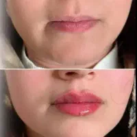 فیلر صورت و بدن