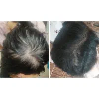 مشاوره تخصصی ریزش مو ( رایگان )