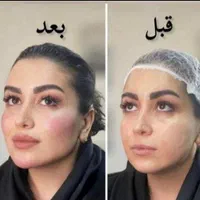 ژل بوتاکس فیلر چشم زاویه فک گونه چانه فشیال بیکینی|خدمات آرایشگری و زیبایی|قم, زنبیل آباد|دیوار