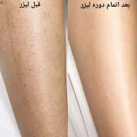 لیزر موهای زائد افرو بدون درد تضمینی