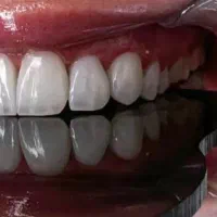 لمینیت،کامپوزیت،عصب کشی،ترمیم