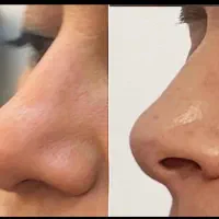 کوچک شدن بینی تضمینی فقط با ۵ میلیون|خدمات آرایشگری و زیبایی|تهران, هاشمی|دیوار