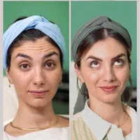 تزریق فیلر وبوتاکس مزو آنزیم پی ارپی و چربی|خدمات آرایشگری و زیبایی|کرمانشاه, |دیوار