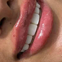 ژل لب گونه چونه زاویه فک خط خنده بوتاکس فقط ۲۹۰|خدمات آرایشگری و زیبایی|قم, سالاریه|دیوار