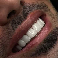 دندانپزشکی،کامپوزیت دندان،روکش دندان|خدمات آرایشگری و زیبایی|شیراز, شهرک ولیعصر|دیوار