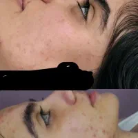 فشیال درمانی کربوکسی