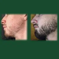 پکیج رویش و پرپشتی ریش و مو