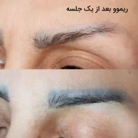 ریموو درمانی تتو های بدرنگ قدیمی|خدمات آرایشگری و زیبایی|الشتر, |دیوار