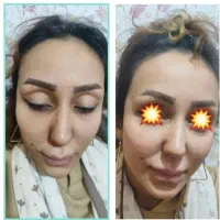 ژل بوتاکس و انزیم|خدمات آرایشگری و زیبایی|شیراز, لشکری‎|دیوار