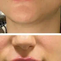 بوتاکس،میکرو،شیدینگ تخفیف ویژه|خدمات آرایشگری و زیبایی|بیرجند, |دیوار