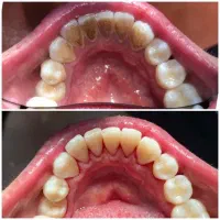 جرم گیری با بیمه سلامت 1750 با بیمه تامین 750