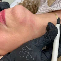 لیزر موهای زائد سفید و سیاه