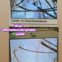 اسکراپ اسکالپ درمان قطعی ریزش مو