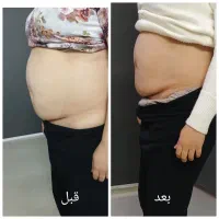 لیزر|خدمات آرایشگری و زیبایی|گلبهار, شهر جدید گلبهار|دیوار