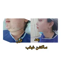ساکشن چربی بلفاروپلاستی لابیاپلاستی ژل بوتاکس|خدمات آرایشگری و زیبایی|شیراز, ملاصدرا|دیوار
