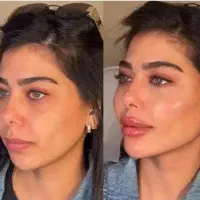 فول فیس/ژل لب/آنزیم بلفارو بوتاکس هایفو تخفیف۶۰٪