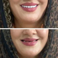 انواع دندان های مصنوعی