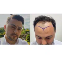 کاشت مو و ابرو|خدمات آرایشگری و زیبایی|تهران, دزاشیب|دیوار