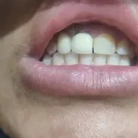 دندان مصنوعی|آرایشی، بهداشتی، درمانی|لردگان, |دیوار