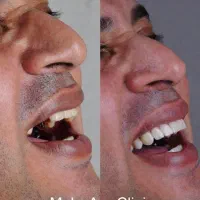 ایمپلنت با روکش هدیه 12.600 محدود|خدمات آرایشگری و زیبایی|تهران, ستارخان|دیوار